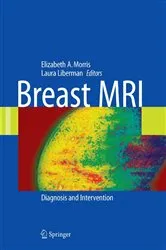 Book cover of Breast MRI by Laura Liberman