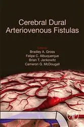 Book cover of Cerebral Dural Arteriovenous Fistulas by Bradley A. Gross