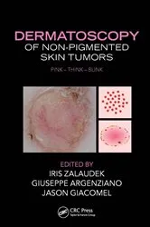 Book cover of Dermatoscopy of Non-Pigmented Skin Tumors by Iris Zalaudek