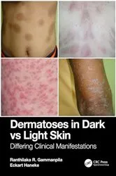 Book cover of Dermatoses in Dark Vs Light Skin by Ranthilaka R. Gammanpila