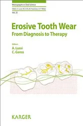Book cover of Erosive Tooth Wear by A. Lussi