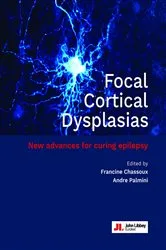 Book cover of Focal Cortical Dysplasias by Francine Chassoux