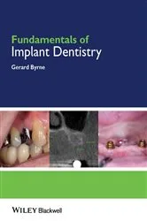 Book cover of Fundamentals of Implant Dentistry by Gerard Byrne