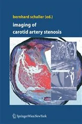 Book cover of Imaging of Carotid Artery Stenosis by Bernhard Schaller