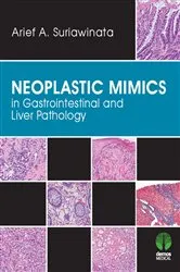Book cover of Neoplastic Mimics in Gastrointestinal and Liver Pathology by Arief Suriawinata