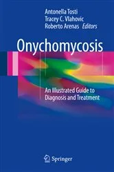Book cover of Onychomycosis by Antonella Tosti