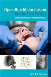 Book cover of Open-Bite Malocclusion by Guilherme Janson