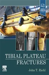 Book cover of Tibial Plateau Fractures - E-Book by John Riehl MD