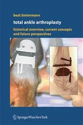 Book cover of Total Ankle Arthroplasty by Beat Hintermann
