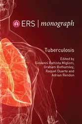 Book cover of Tuberculosis by Giovanni Battista Migliori